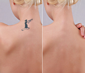 Tattoo Removal Before  After  IOIO Studio