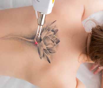 Mayfield Heights patients ask, “Does laser tattoo removal hurt?”