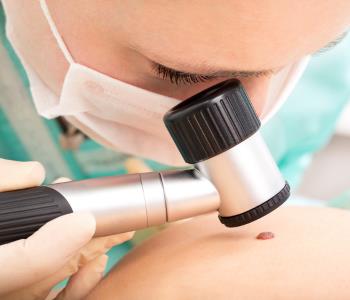 Mole Removal Options from Mentor Dermatologists