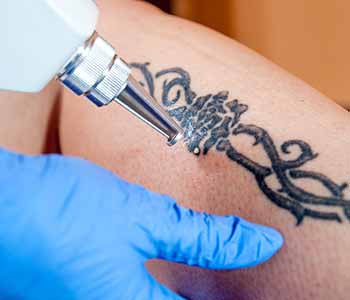 What to expect Laser Tattoo Removal in Akron, OH area