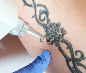 Are tattoo removal procedures effective in Akron, Ohio?