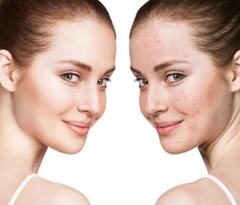 Acne Treatment for Scars in Akron Ohio (Dermatologists)