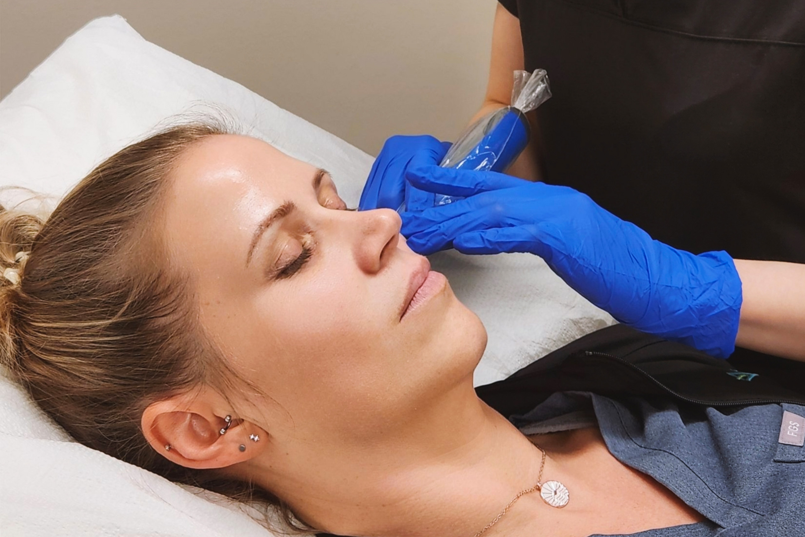 Unlock Radiant Skin with Microneedling Scar Removal